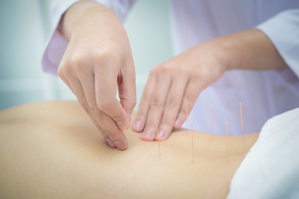 Expat Guide to Acupuncture